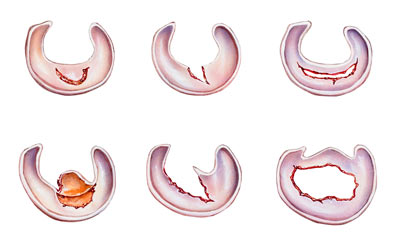 Meniscus tears